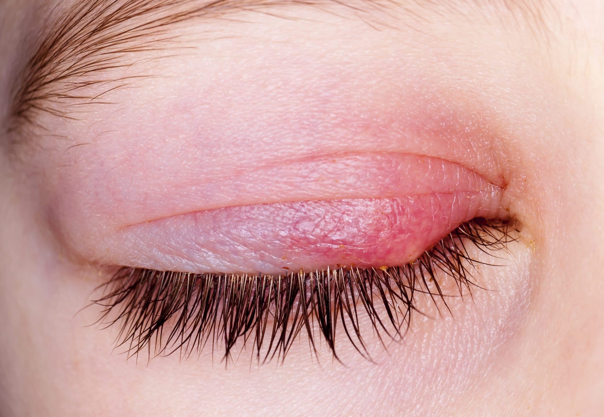 10 Best Stye and Chalazion Remedies in 2024 WebSta.ME