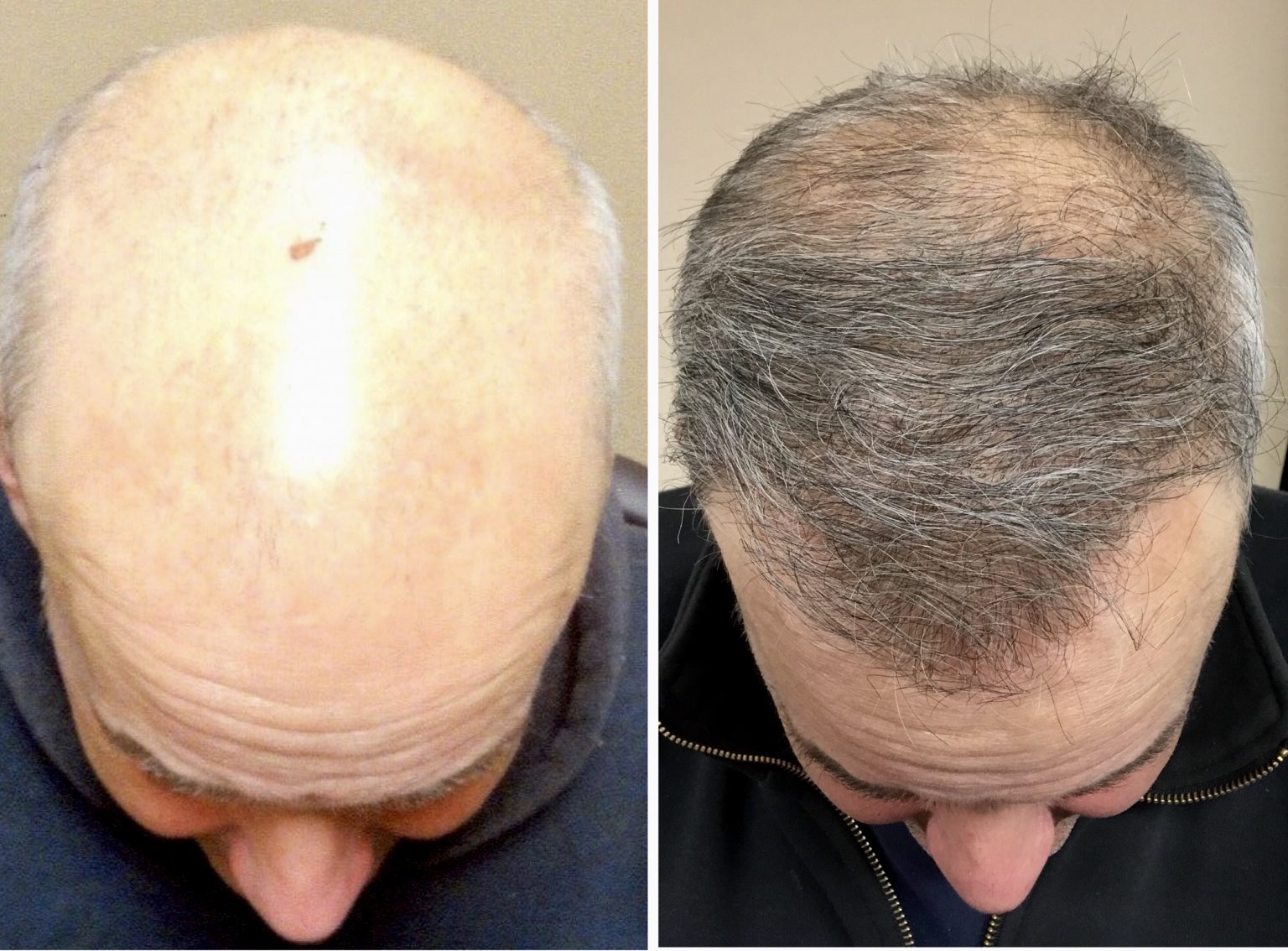 Are Hair Transplant Procedures Worth The Money 2024 Guide Sta.ME