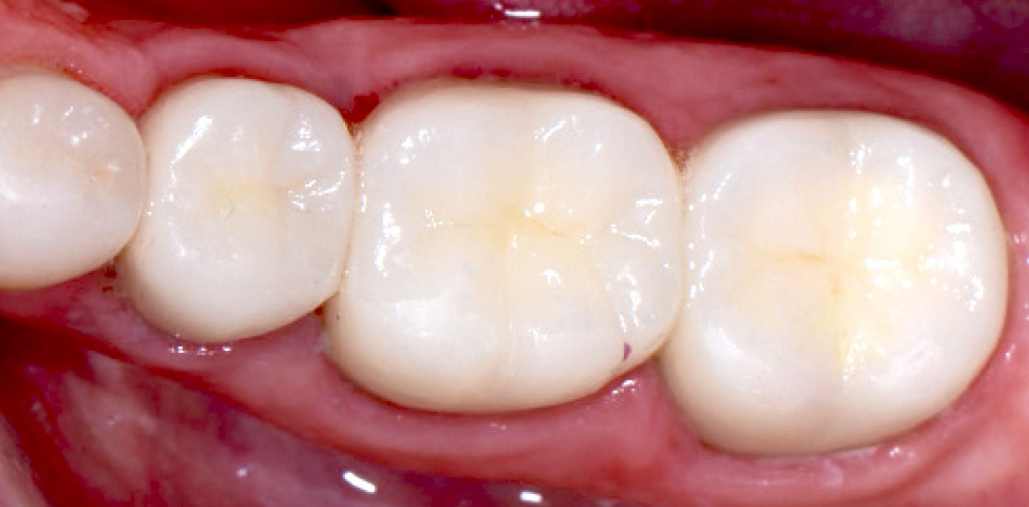 Why Should you Choose White NonMetal Dental Fillings 2024 Guide