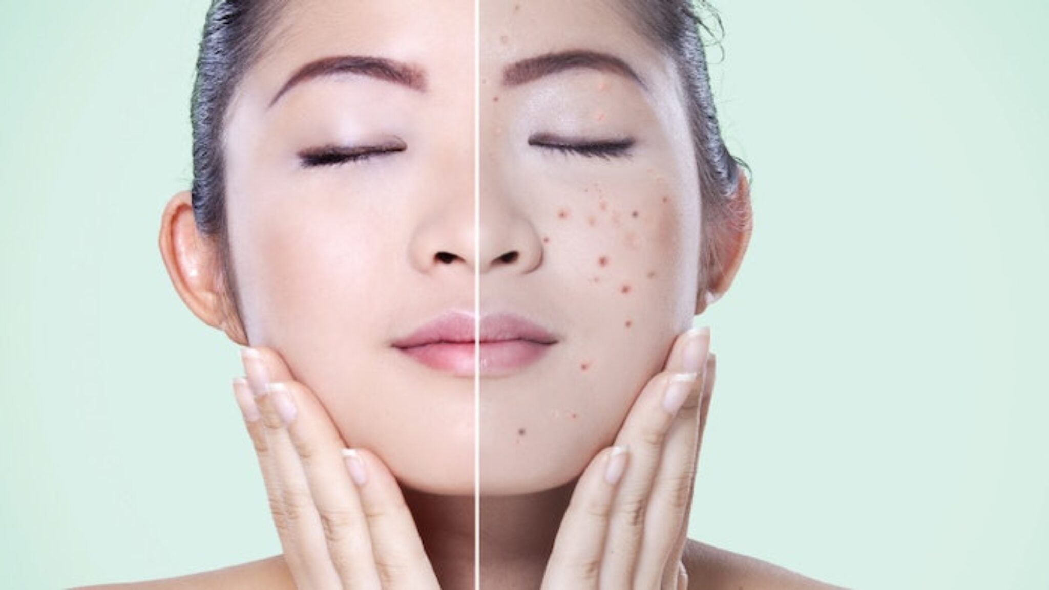 Achieving Clear Skin A Comprehensive Guide to AcneProofing