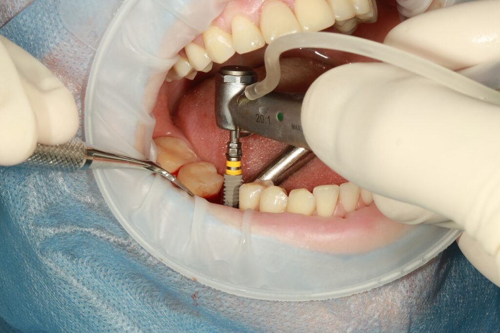 A Closer Look at the Implant Procedure