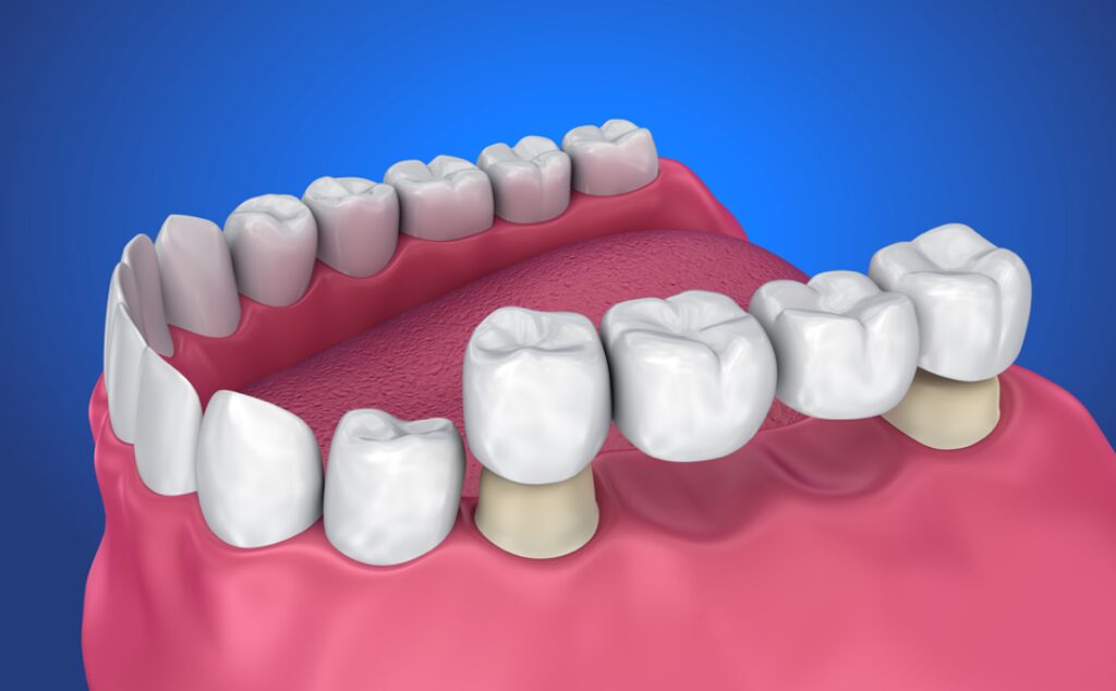 Dental Implants and Bridges