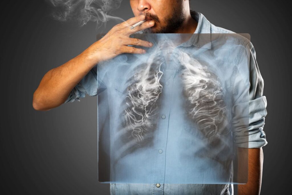 Smoking-The Biggest Cause of Lung Cancer