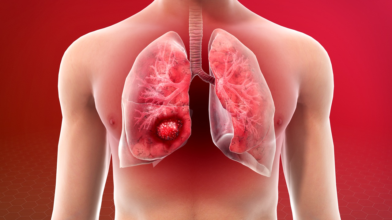What Are the Biggest Causes of Lung Cancer