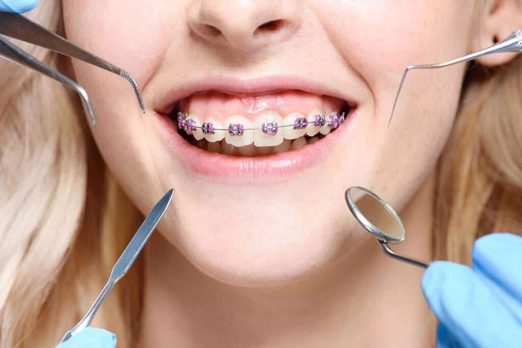early orthodontics