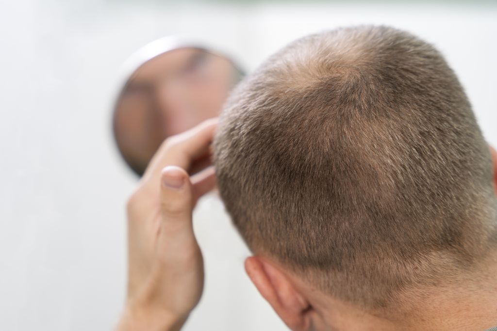 male hair loss