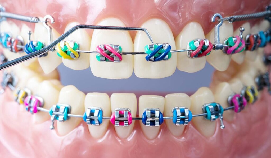 orthodontics colorful
