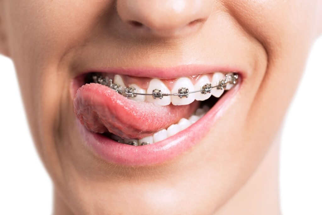right age for orthodontics