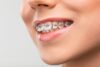 Orthodontic Braces