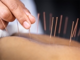 5 Things to Know When Using Acupuncture for Stress Relief – 2024 Guide