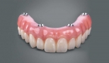 What You Need To Know About All On Four Dental Implants – 2024 Guide
