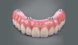 What You Need To Know About All On Four Dental Implants – 2024 Guide
