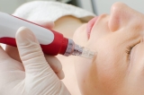 Here’s Everything You Need To Know About Microneedling