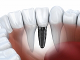 Why Should you Go for Dental Implants in 2024?