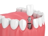 Common Myths About Dental Implants
