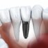 Open Spine Surgery vs. Minimally Invasive Surgery: Which is Better in 2024?
