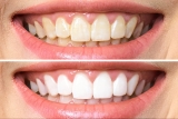How Frequently Should You Get Professional Teeth Whitening