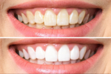 How Frequently Should You Get Professional Teeth Whitening