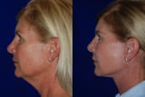 What is the Difference Between a Facelift and a Neck Lift in Sydney – 2024 Guide