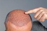 6 Reasons To go Abroad for a Hair Transplant – 2024 Guide
