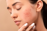 Dietary Changes for Reducing Hormonal Acne