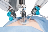 What is the Benefit of Laparoscopic Hysterectomy Surgery in Sydney? – 2024 Guide