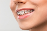 Perfecting Your Bite, Elevating Your Confidence: The Dual Power of Orthodontic Braces