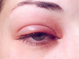 10 Best Stye and Chalazion Remedies in 2024