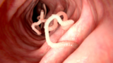 Tapeworm Diet: Weight Loss, Risks and Side Effects – 2024 Guide