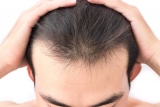 5 Best Shampoo for Thinning Hair in 2024
