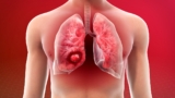 What Causes Lung Cancer?