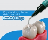 Why Should you Choose White Non-Metal Dental Fillings – 2024 Guide