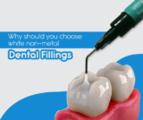 Why Should you Choose White Non-Metal Dental Fillings – 2024 Guide